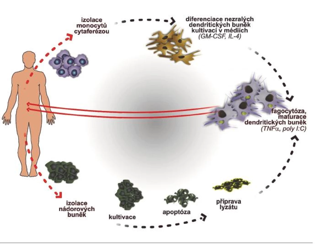 Schéma přípravy vakcinace dendritickými buňkami stimulovaných autologními apoptotickými nádorovými buňkami
