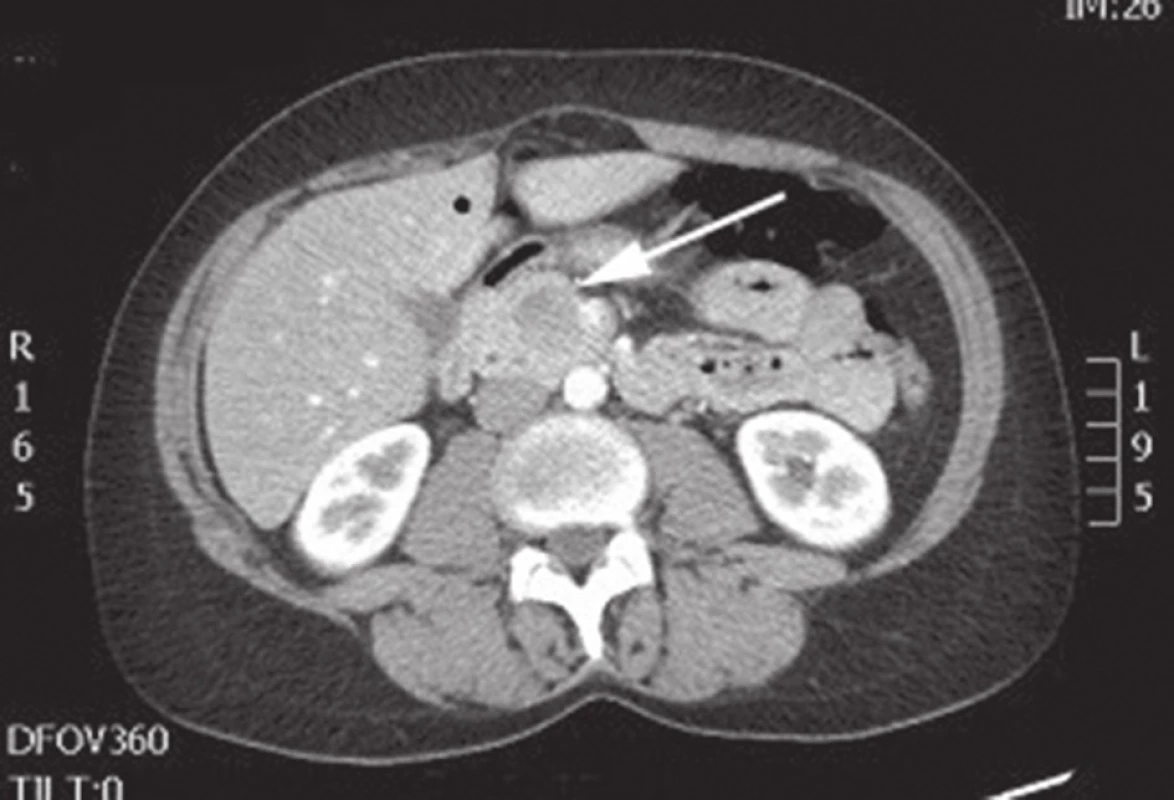 CT břicha s nálezem SPN v oblasti hlavy pankreatu
Fig. 3: Abdominal CT with the finding of SPN of the head of the pancreas