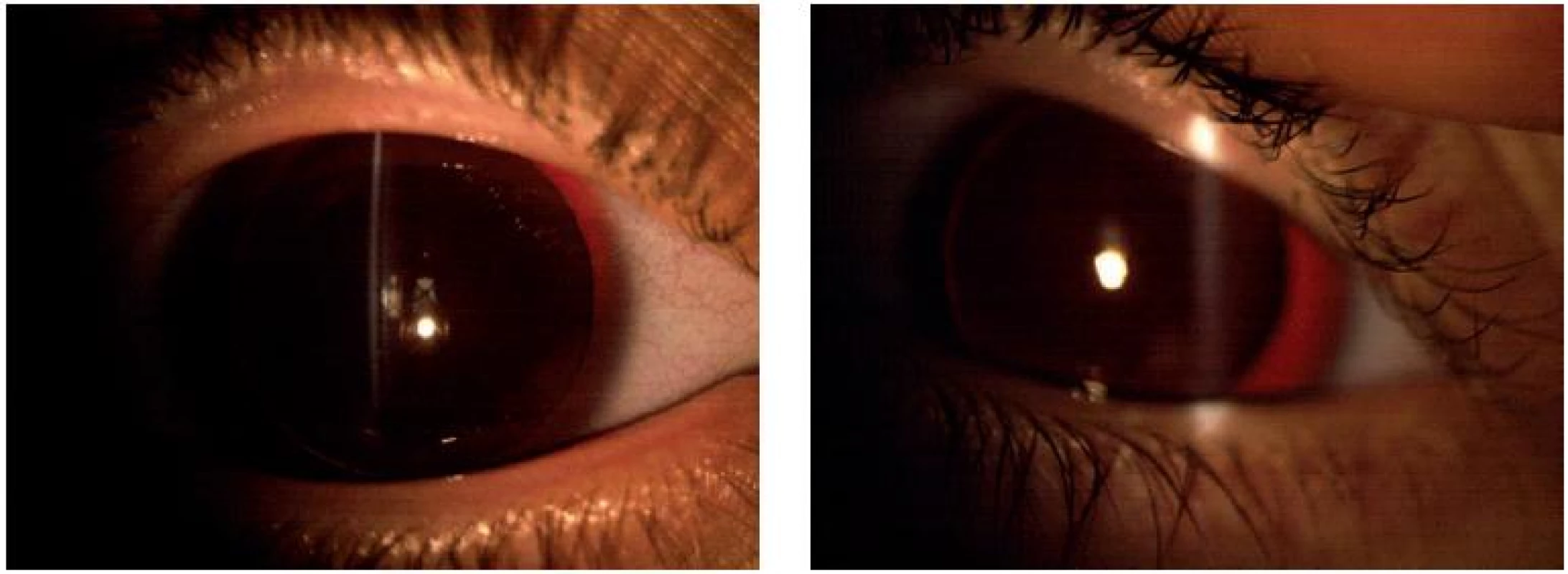 Pacientka III- 2: pravé (A) a levé (B) oko, je zachycená aniridie, viditelný ekvátor čočky, rohovkové změny minimální, zachycená katarakta vpravo.