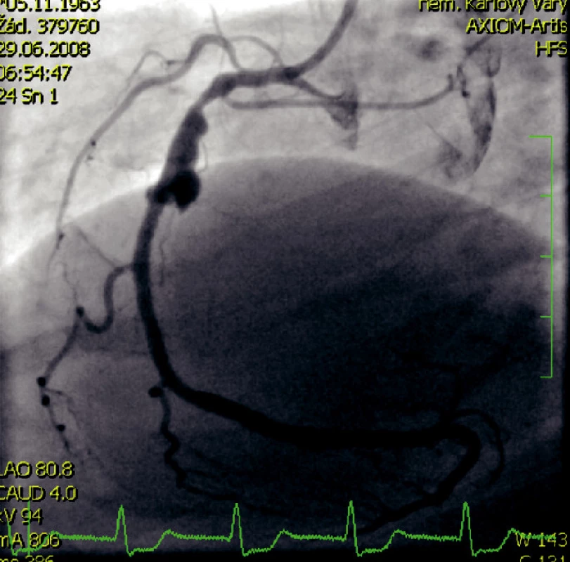 Kontrolní koronarografický nástřik pravé koronární tepny po rekanalizaci šipka ukazuje aneurysma pravé koronární arterie v místě původního uzávěru