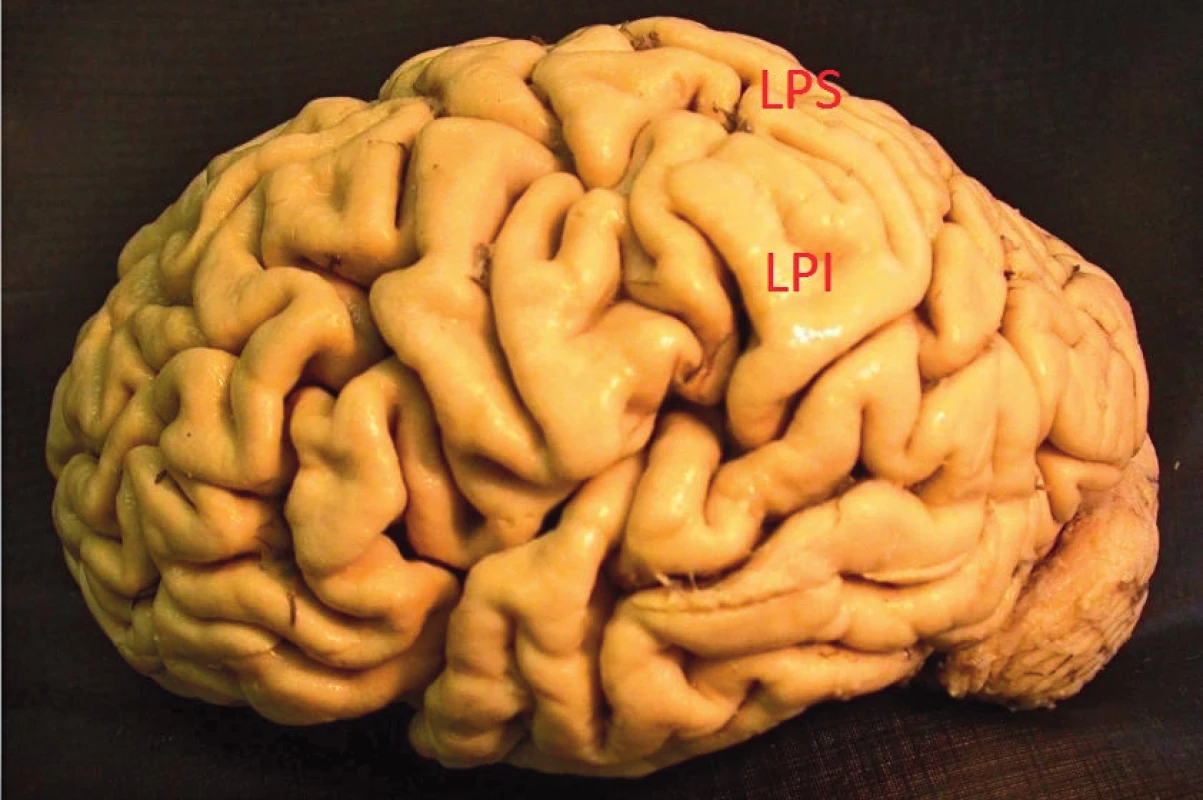 Zevní plocha levé hemisféry, temenní lalok dělí intraparietální rýha na dva oddíly: LPS – lobulus parietalis superior, LPI – lobulus parietalis inferior
