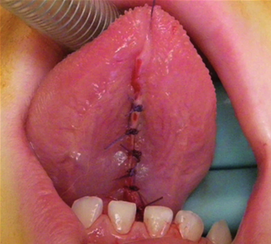 Stav po frenulektomii – sutura jednotlivými stehy.
Fig. 3. Status after frenulectomy: suture by individual stitches.
