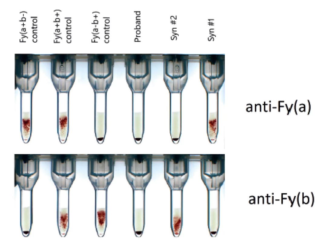 Typování Duffy antigenů metodou sloupcové aglutinace