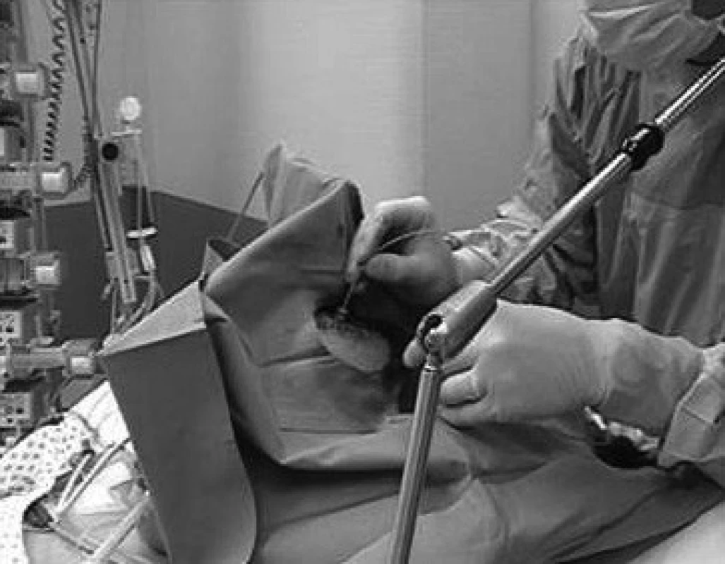 Zavádění intrakraniálního čidla chirurgem po navrtání lebeční kosti předního zkříženého vazu
