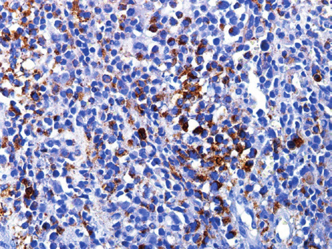 Kazuistika 12. Sarkom ze světlých buněk. V nálezu převažovala kulatobuněčná morfologie s vakuolizovanou světlou cytoplasmou nádorových buněk. Tyto buňky jsou větší než nádorové buňky například u Ewingova sarkomu. Nádor reagoval fokálně silně s protilátkou HMB45. Imunohistochemická reakce, dobarveno hematoxylinem (původní zvětšení 200x).