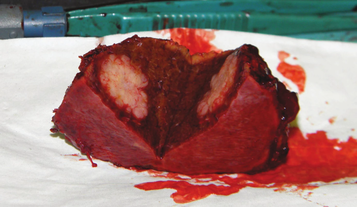 Operační nález: rozkrojený preparát po neanatomické resekci jater
Fig. 4: Intraoperative finding: a part of the liver with metastatic tumour