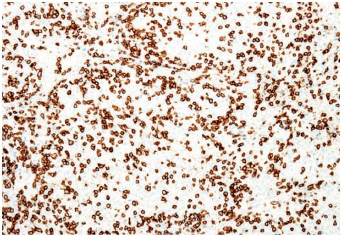 Pozitivita Cd8 lymfocytů při imunohistochemickém vyšetření metastázy