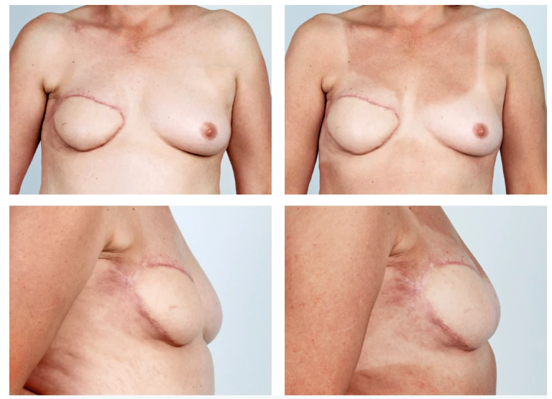 A 51-year-old patient with the history of secondary breast reconstruction using abdominal flap before and 5 months after one lipomodelling session with 180 ml of fat