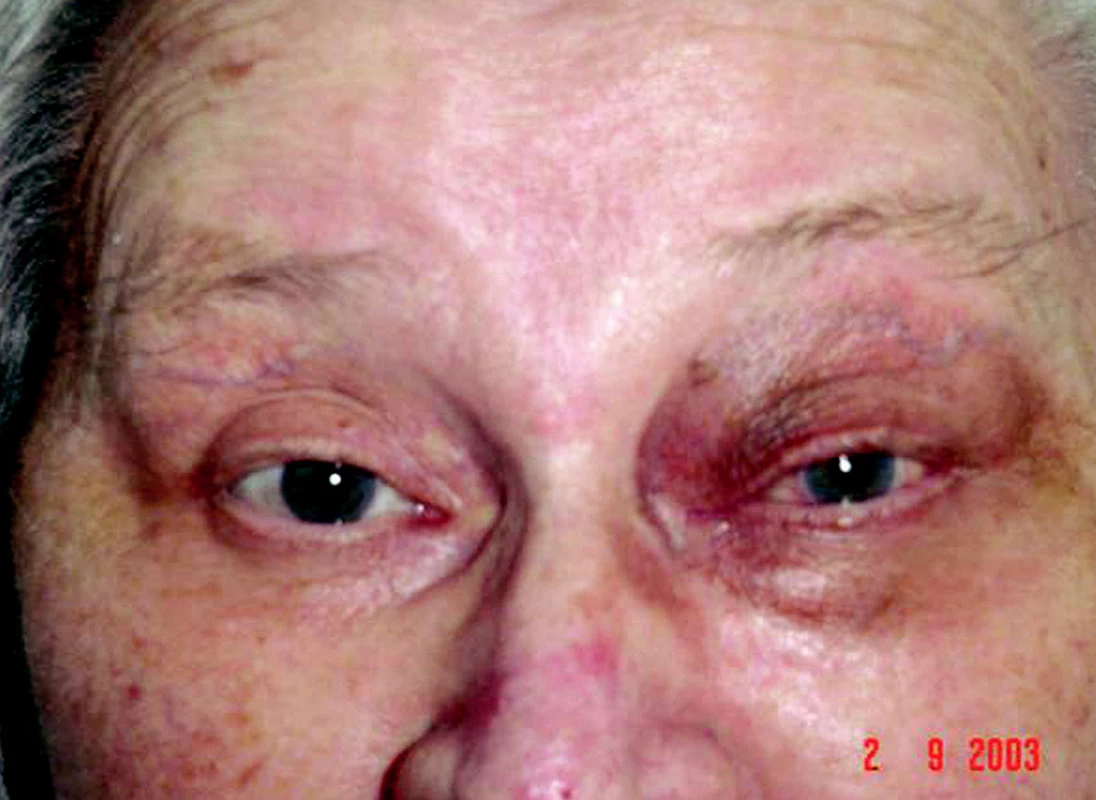 Snímka po troch mesiacoch, bez protrúzie ľavého bulbu, periokulárna pigmentácia kože