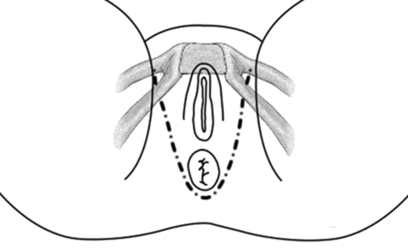 Schéma umístění pásky
Fig. 1: Outline of the anal sling position