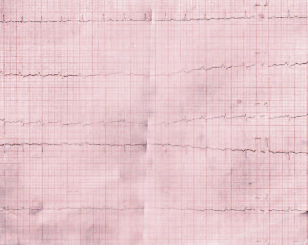 EKG záznam z dokumentácie.