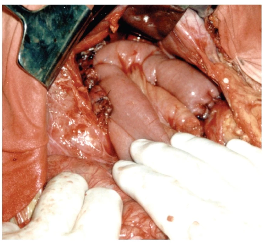 Roux klička s implantací proximální i distální částí pankreatu