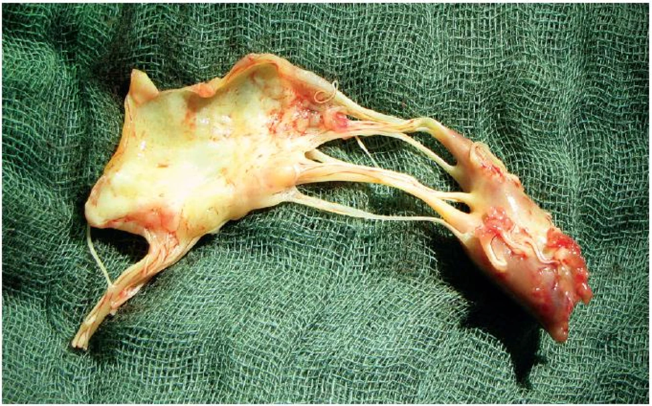 Rupturovaný papilární sval, včetně předního cípu a části závěsného aparátu, excidovaný chirurgem během výkonu