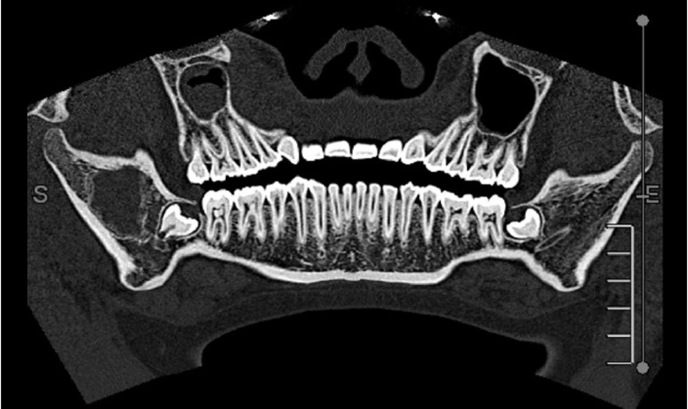 Na CT snímku (převedený do OPG zobrazení) patrná rozsáhlá cysta pravé větve mandibuly za zárodkem zubu 48