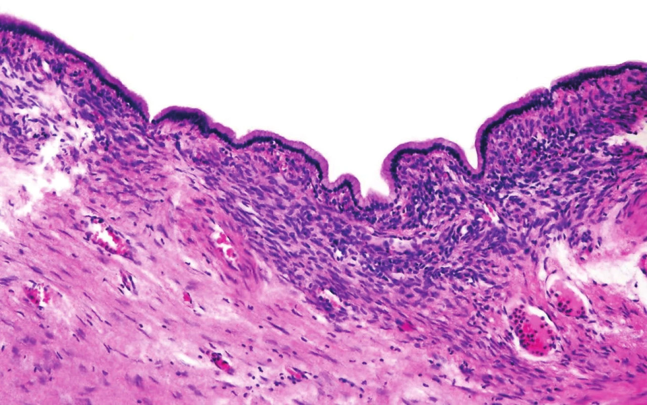 Cysty jsou vystlány jednovrstevným hlenotvorným cylindrickým epitelem nasedajícím na bazální membránu. Subepiteliálně mezenchymální ovarian-like stroma; vnější vrstva tvořena denzním hyalinizovaným vazivem
Fig. 2. The cysts are lined with one-layer muciparous columnar epithelium which adjoins the basal lamina.Sub-epithelially mesenchymal ovarian-like stroma: the outer layer consist of dense hyalinized fibrous tissue