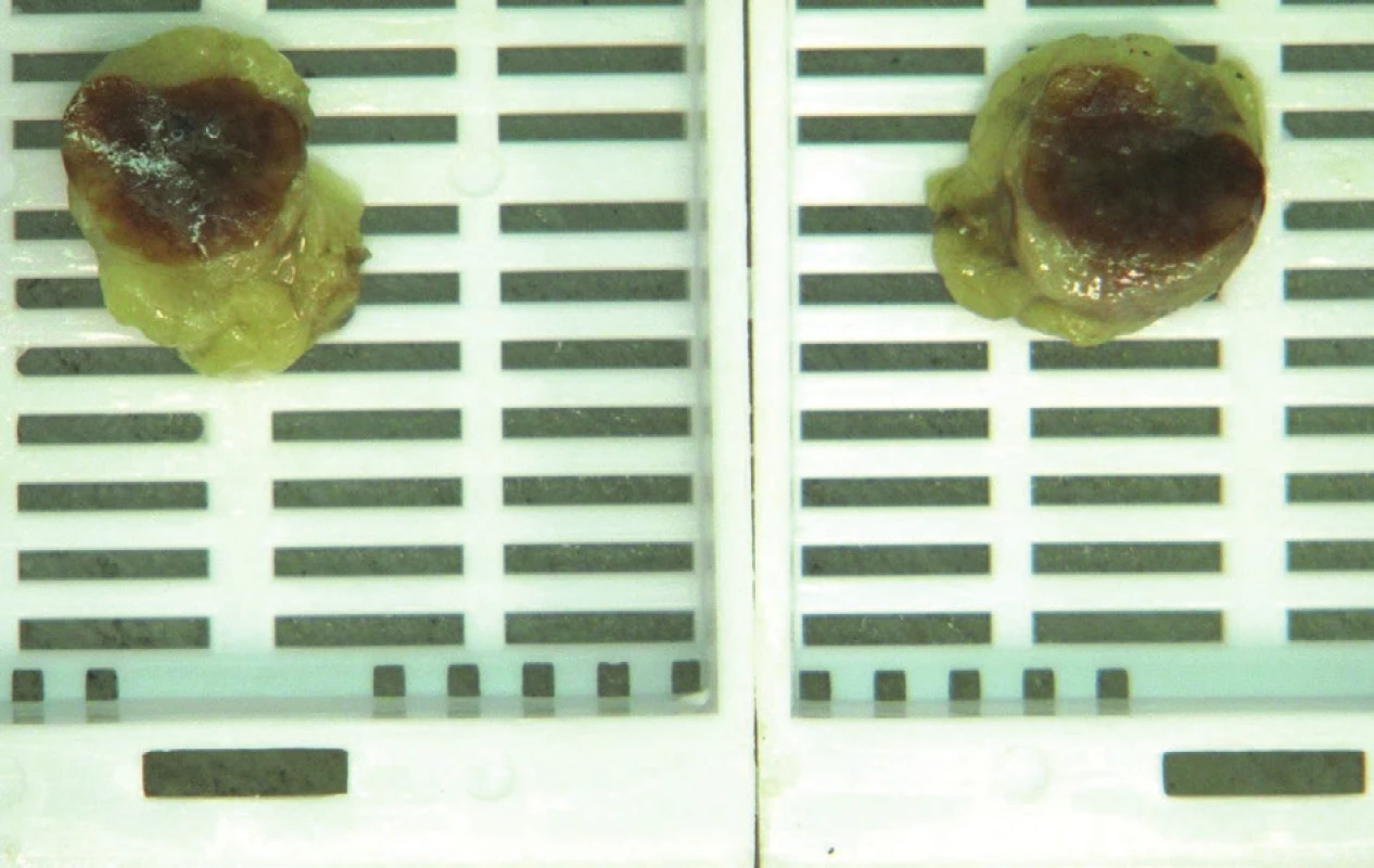 Přikrojená sentinelová uzlina vykazující výrazné hnědé zbarvení způsobené přítomností Sienny
Fig. 3: Sentinel lymph node brownish-colored with the Sienna+ tracer