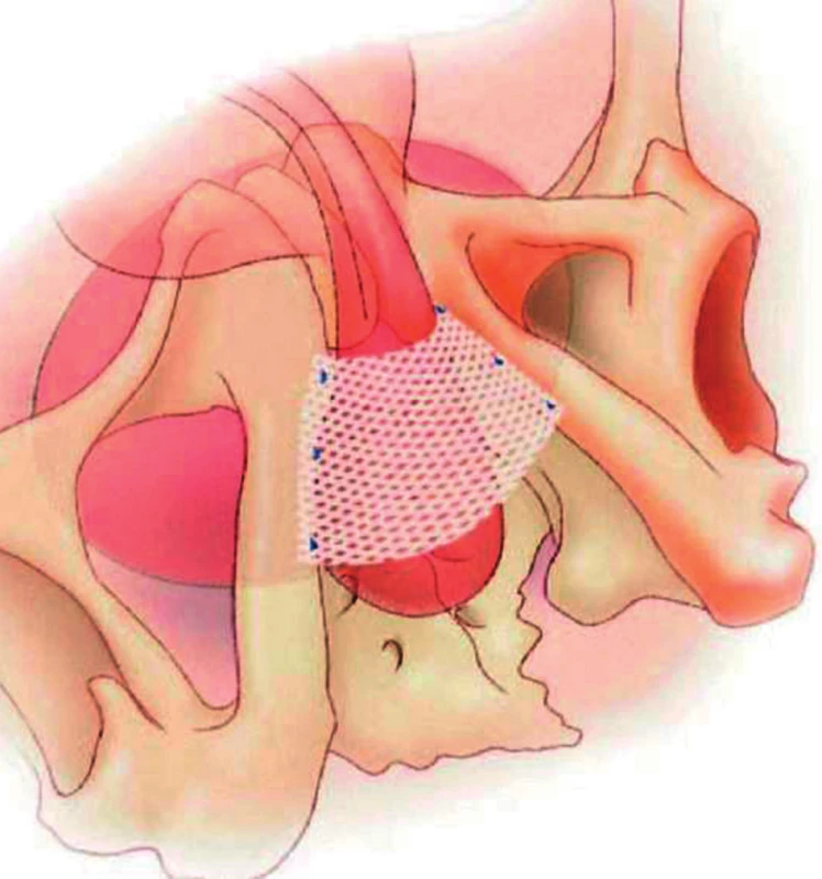 Schéma umístění pásky InVance na oblast bulbární uretry a její fixace ke stydkým kostem