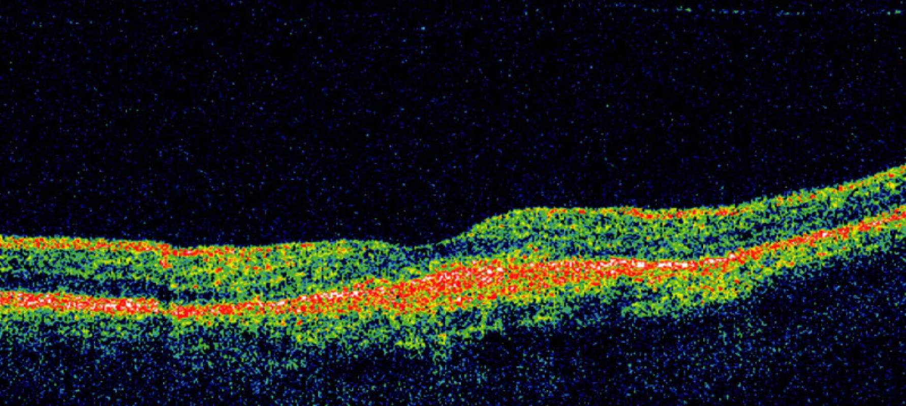 OCT scan (180 st.) pravého oka pacienta 3 měsíce po FTV/RIV