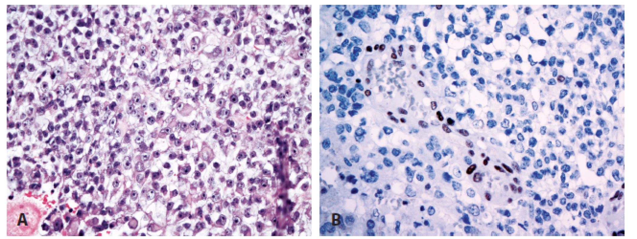 Atypický teratoidní/rhabdoidní nádor (A) se ztrátou imunoexprese INI1 proteinu při pozitivní vnitřní kontrole (B) (400x).