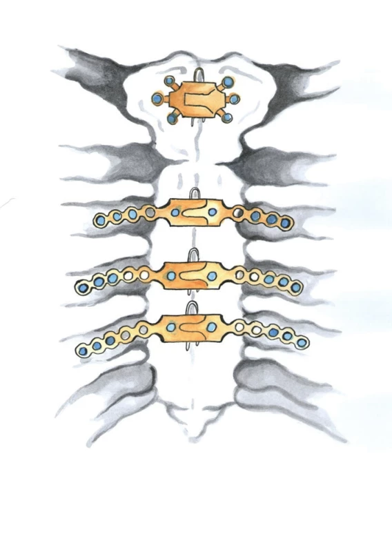 Dlahová osteosyntéza sterna (Kresba archiv autora)
Fig. 10: Sternal plating system