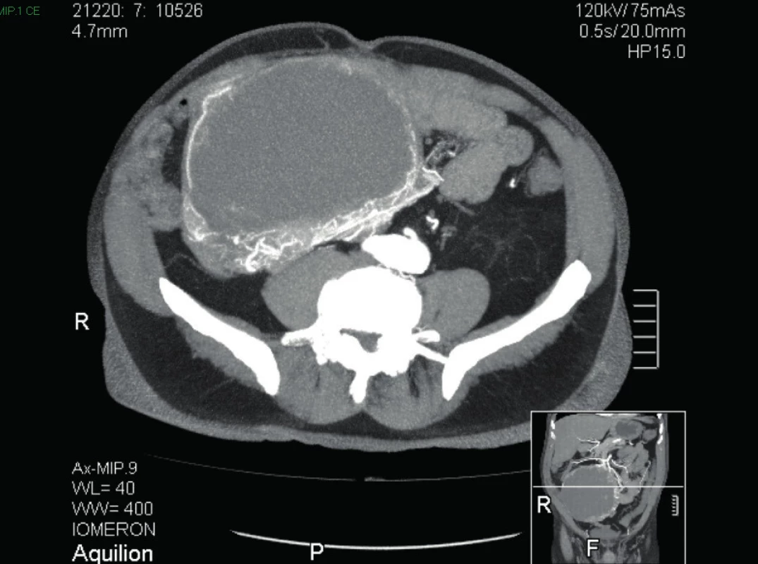 CT břicha a malé pánve MIP (maximum intensity projection ) v axiální rovině
Fig. 4: CT scan of abdomen and pelvis MIP (maximum intensity projection ) axial view
