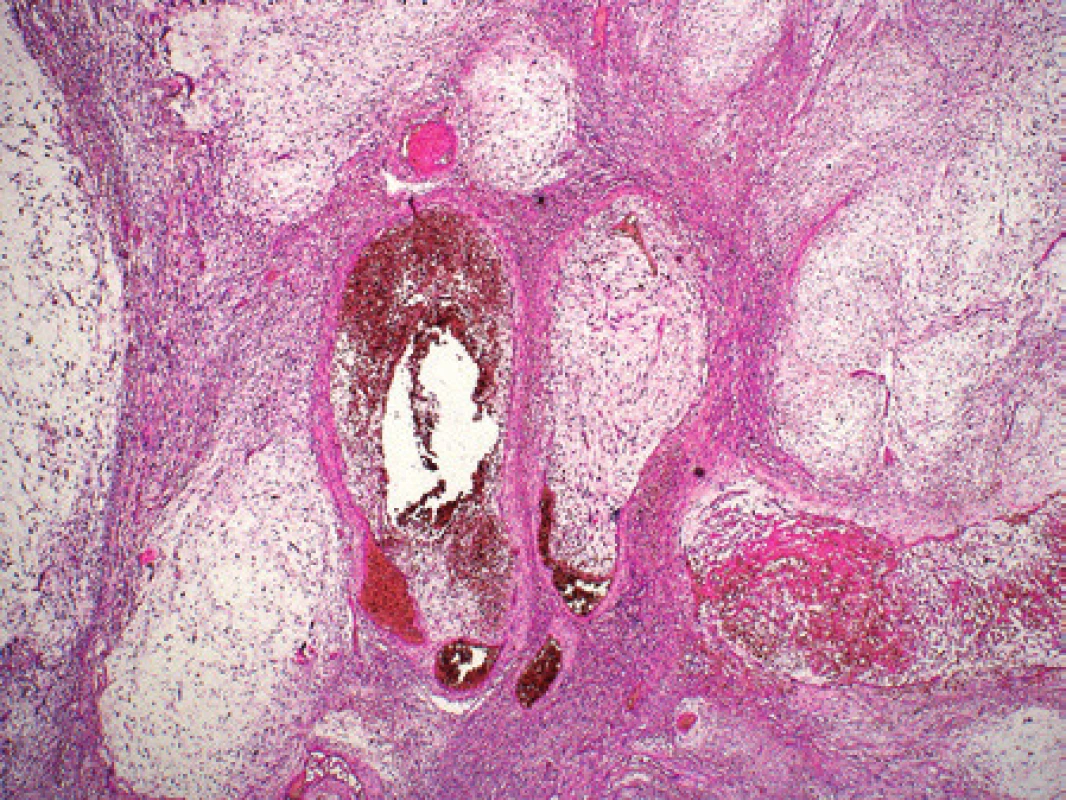 Kazuistika 2. Low grade fibromyxoidní sarkom. Nádor má i v mikroskopickém vyšetření při malém zvětšení naznačeně nodulární uspořádání. Nádorové buňky jsou uloženy v myxoidním stromatu. Barveno hematoxylinem a eozinem (původní zvětšení 40x).