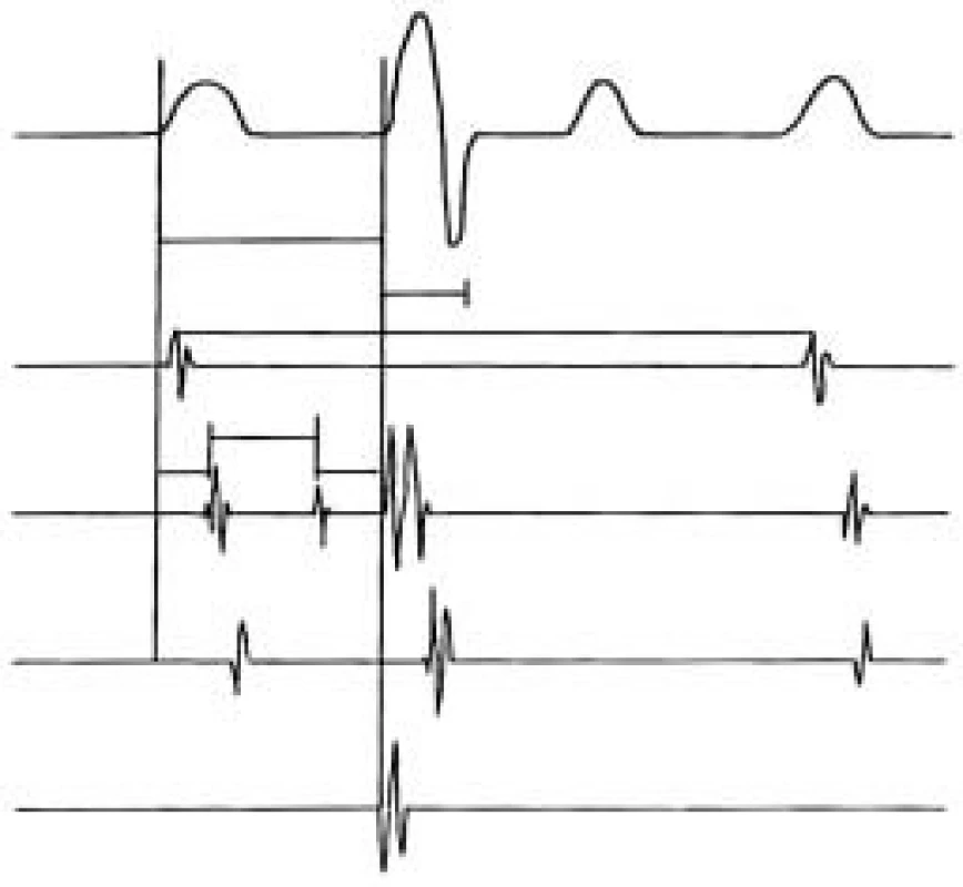 Základní sada intrakardiálních elektrokardiogramů. první stopa – povrchové EKG, druhá stopa – HRA – horní pravá síň s označením základní délky cyklu – BCL, His – hisogram s označeným potenciálem dolní síně A, Hisova svazku H, pravé komory V a základních převodních intervalů IACT – čas intraatriálního vedení, AH – charakterizuje vedení uzlem, HV interval charakterizuje infranodální (distální) vedení vzruchu. CS – coronary sinus – záznam z koronárního sinu, kde je patrný A potenciál z levé srdeční síně a V potenciál z levé srdeční komory, RVA – right ventricular apex – elektrokardiogram z hrotu pravé srdeční komory