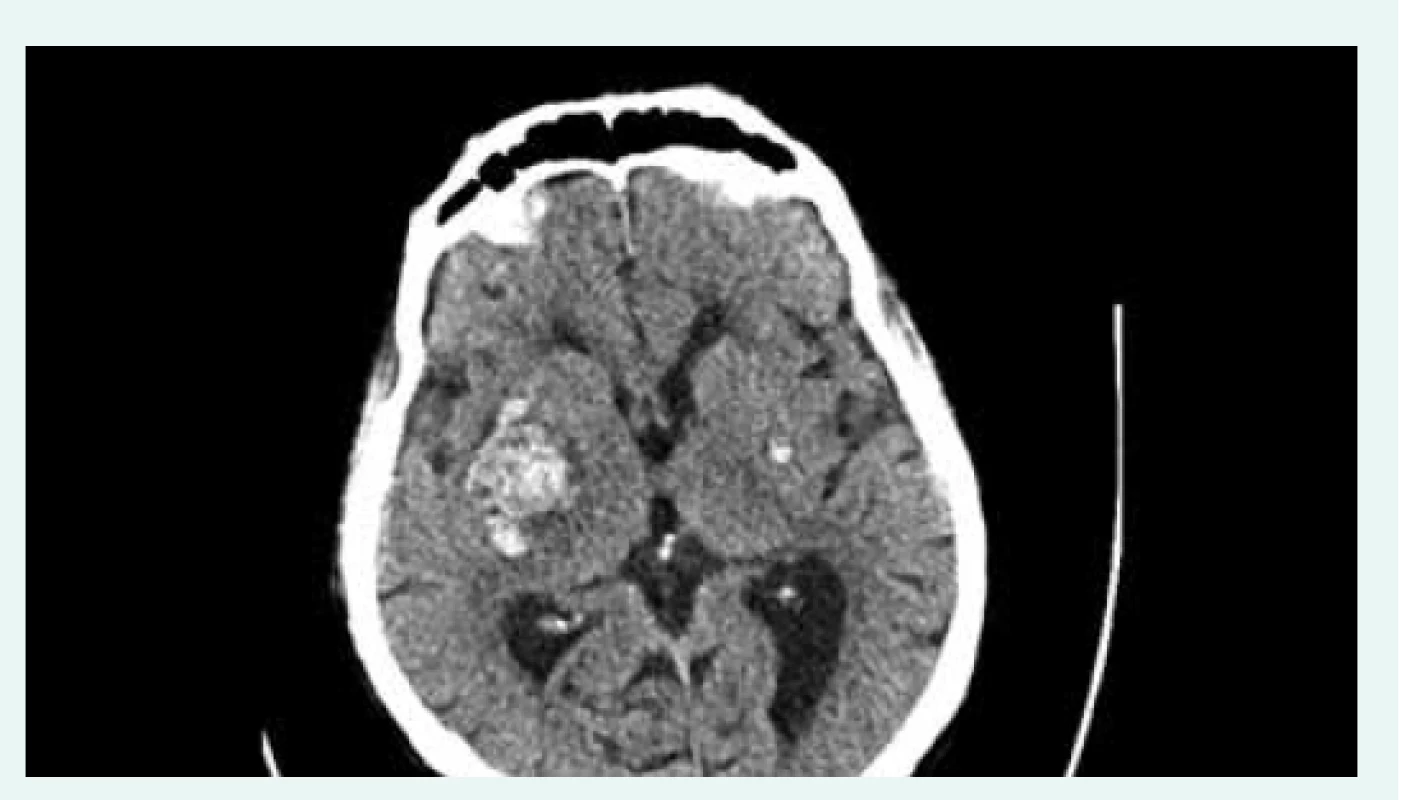Nekontrastní CT mozku. Intracerebrální
hematom vpravo s kompresí postranní komory
s diskrétním přesunem středočárových struktur
doleva. Drobné zakrvácení ve stejné lokalizaci
vlevo. Z archivu autorky