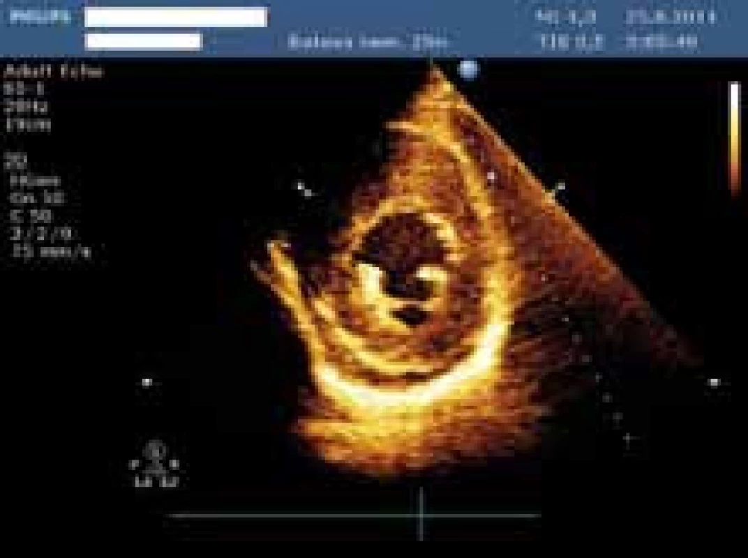 Snímek z echokardiografického vyšetření zobrazující hypertrofovanou levou komoru – parasternální projekce na krátkou osu.