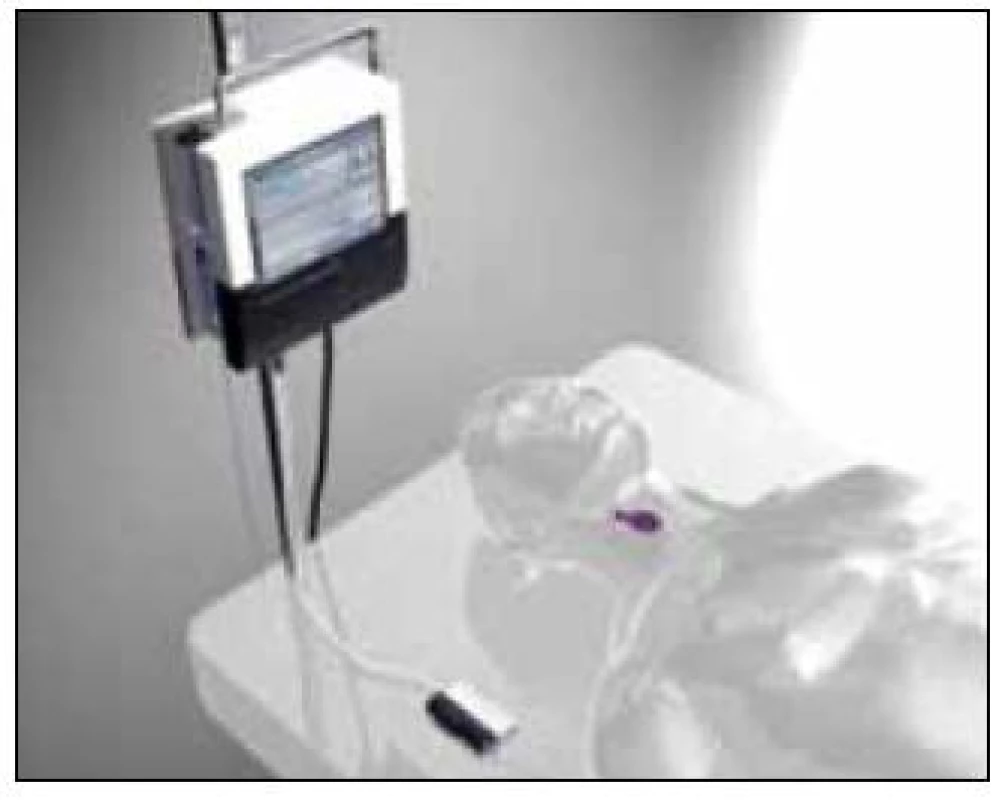 Systém Eirus&lt;sup&gt;TM&lt;/sup&gt; od firmy CMA Microdialysis ke kontinuálnímu sledování glykemie a laktatemie na JIP. Sonda je zavedena cestou centrálního žilního katétru (zdroj: www.microdialysis.se).