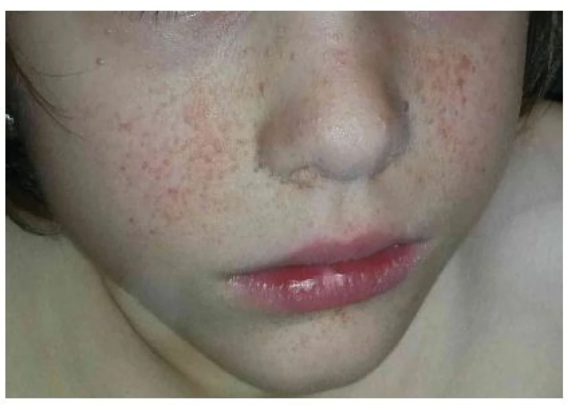 Mnohočetné angiofibromy v obličeji u 8leté dívky