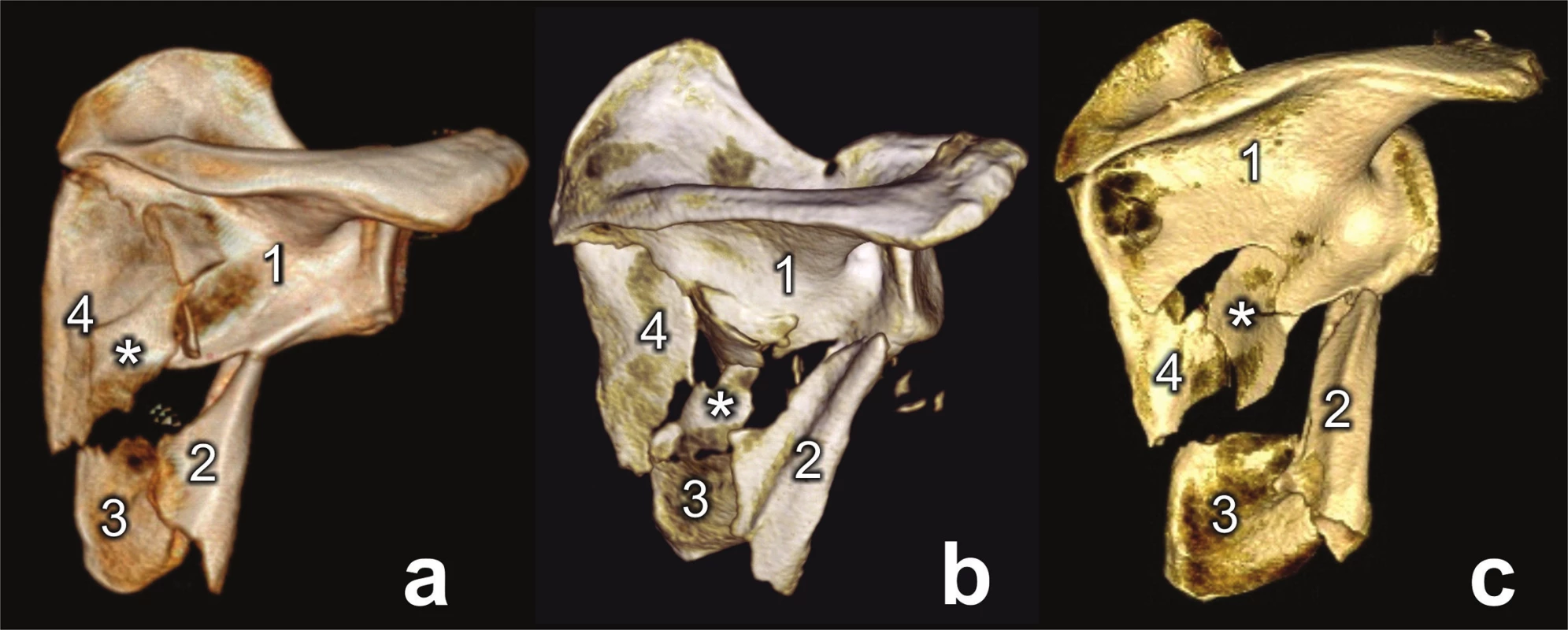 Types of comminuted fracture of lateral pillar (a, b, c)
1 – glenoid fragment, 2 – lateral border fragment, 3 – inferior angle fragment, 4 – medial border fragment, * - intercalary fragment.