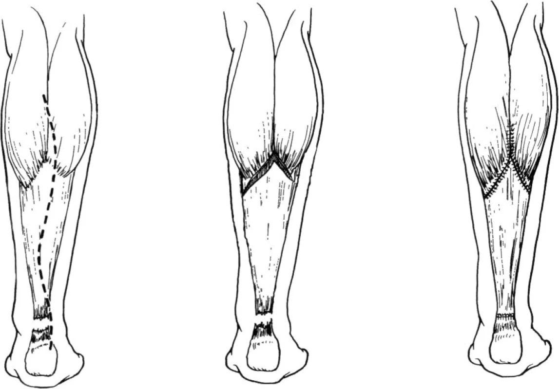 Plastika dle Abrahama a Pankovitcha [1]
(Volně podle Abraham, E., Pankovich, A.M. Neglected rupture of the Achilles tendon: treatment by a V-Y tendinous flap. J Bone Joint Surg Am. 57, 253– 255, 1975)
