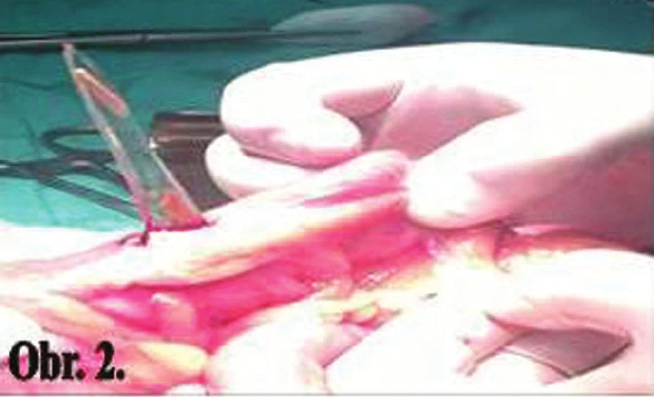 Perforovaná sigma sklom
Fig. 2: Perforation of the sigmoid colon with glass