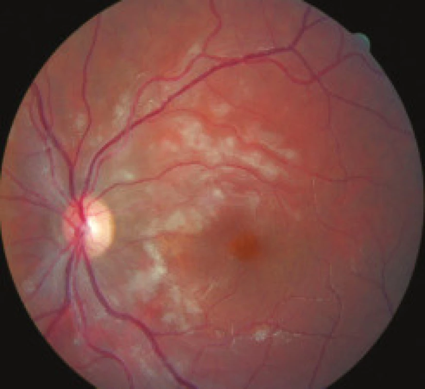 Ľavé oko, mesiac po zahájení liečby, takisto výrazné vstrebávanie belavých ložísk i krvácania na sietnici.