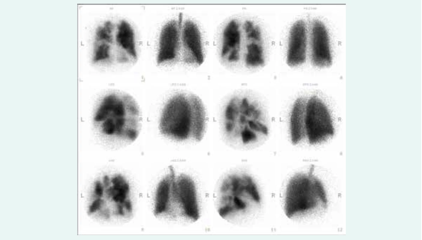 Ventilační a perfuzní scintigrafie plic u nemocného s chronickou tromboembolickou plicní hypertenzí
zobrazující četné defekty v přítomnosti radiofarmaka na perfuzních scanech oboustranně