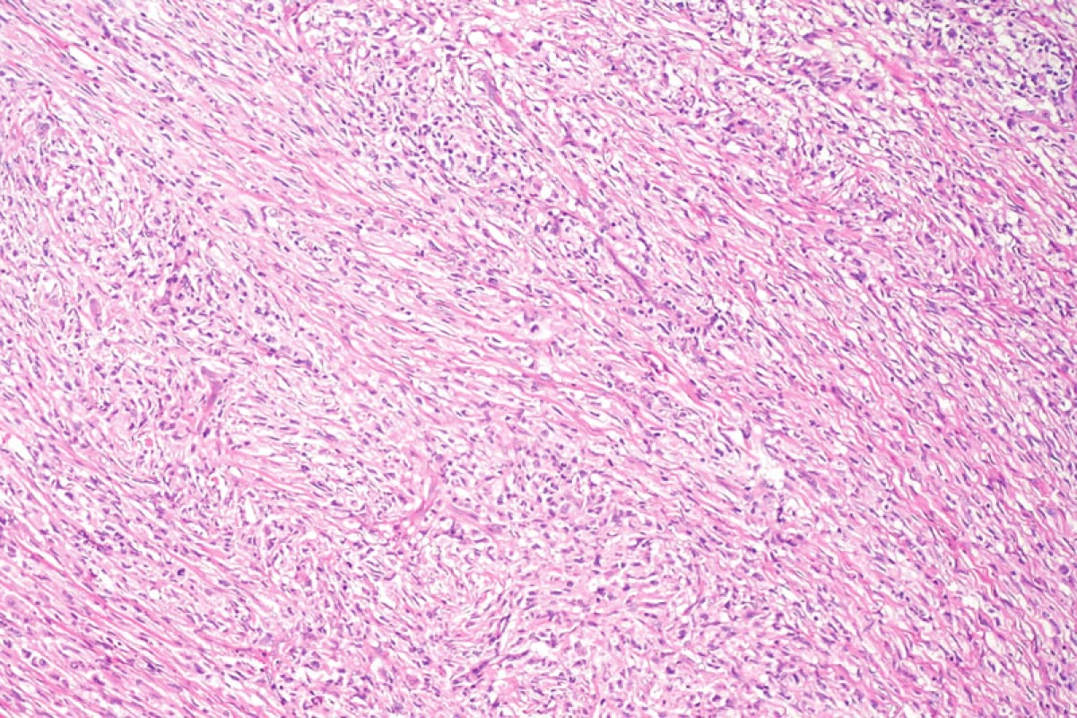 Přehledný snímek solidně rostoucího nádorového infiltrátu krátce vřetenitých buněk. Hematoxylin-eozin, původní zvětšení 100krát.