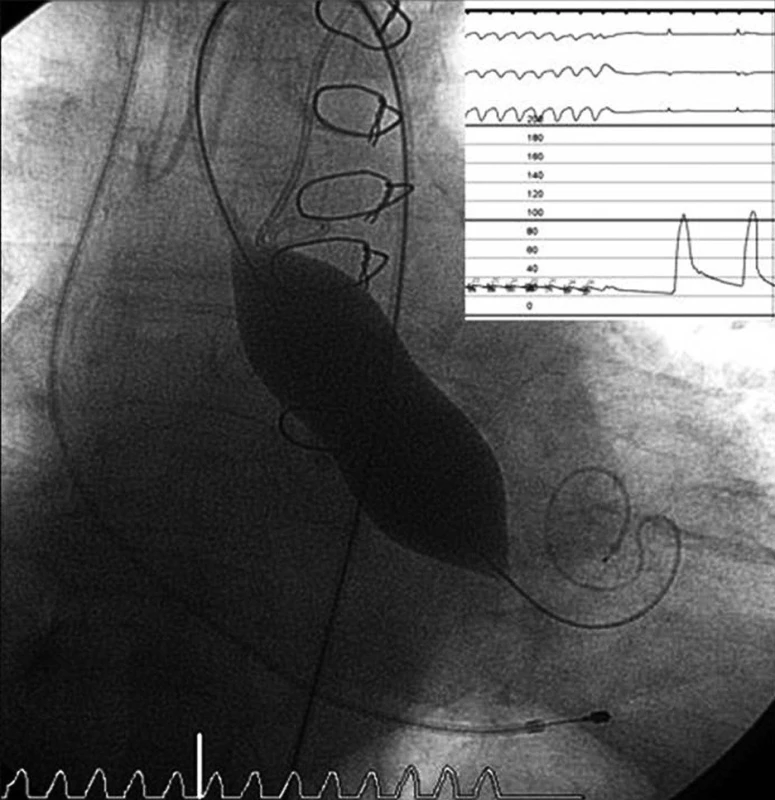 Dilatace aortální chlopně valvuloplastickým balonkem při rychlé komorové stimulaci 
Pacient po předchozí operační revaskularizaci myokardu.