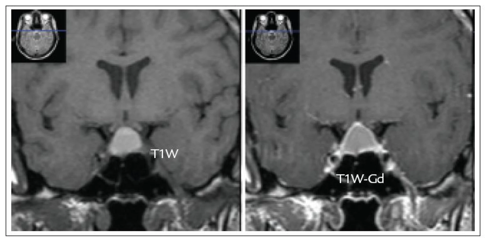 MRI nález cysticky změněného hormonálně afunkčního adenomu hypofýzy s extraselární propagací 31leté pacientky vyšetřené pro demyelinizační onemocnění.