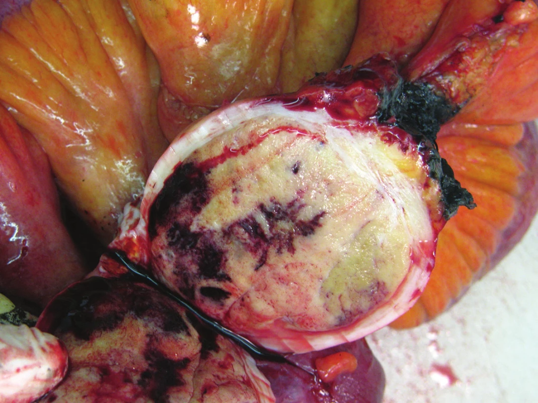 Neuroendokrinní tumor ilea
Fig. 2: Neuroendocrine tumor of the ileum