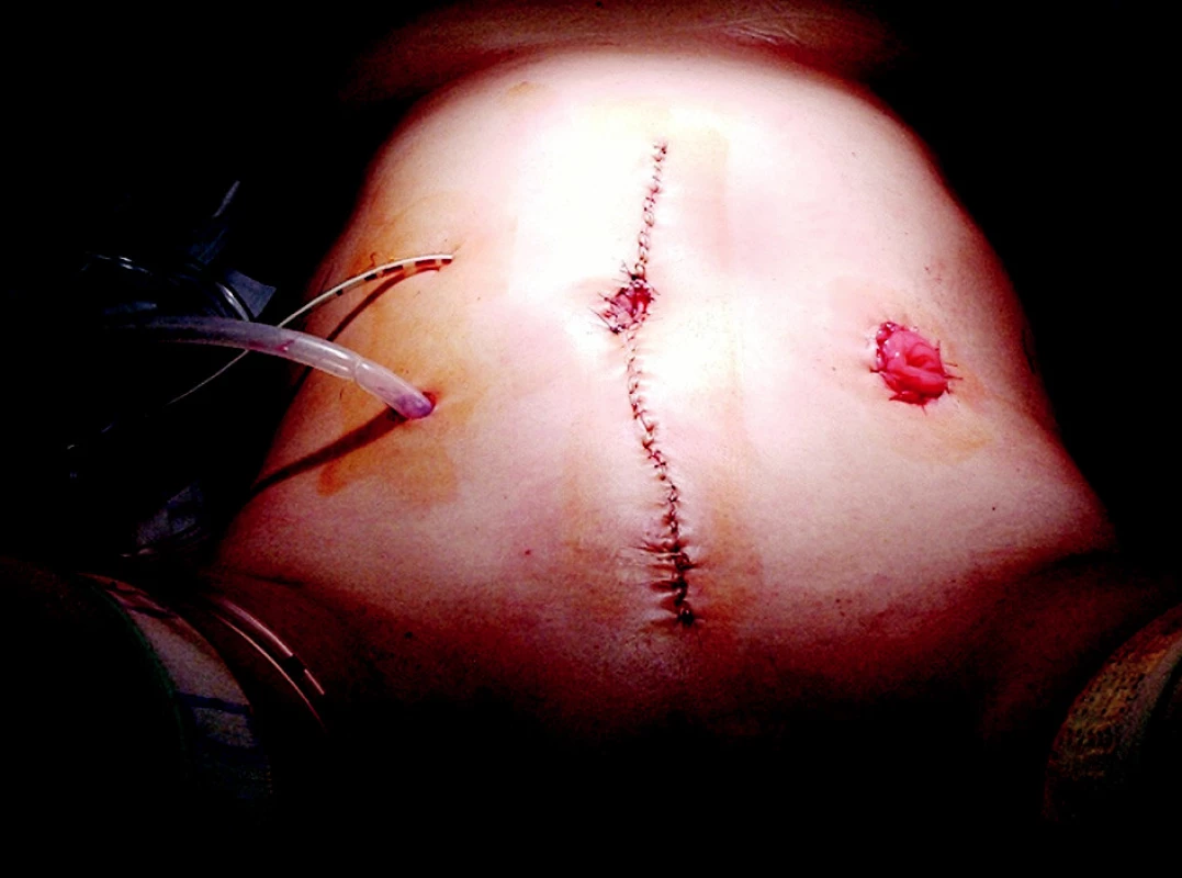 Pacientka č. 1 – výsledný stav – břišní stěna
Fig. 4. Outcome of VRAM flap – abdominal wall