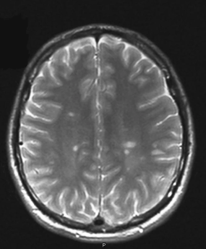 Typický MRI nález u RS.
(Zapůjčeno z oddělení magnetické rezonance Nemocnice na Homolce.)