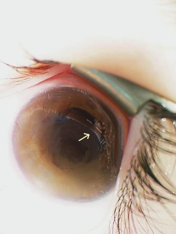 Obraz ľavého oka s tumoróznymi hmotami za dúhovkou v hornom temporálnom kvadrante