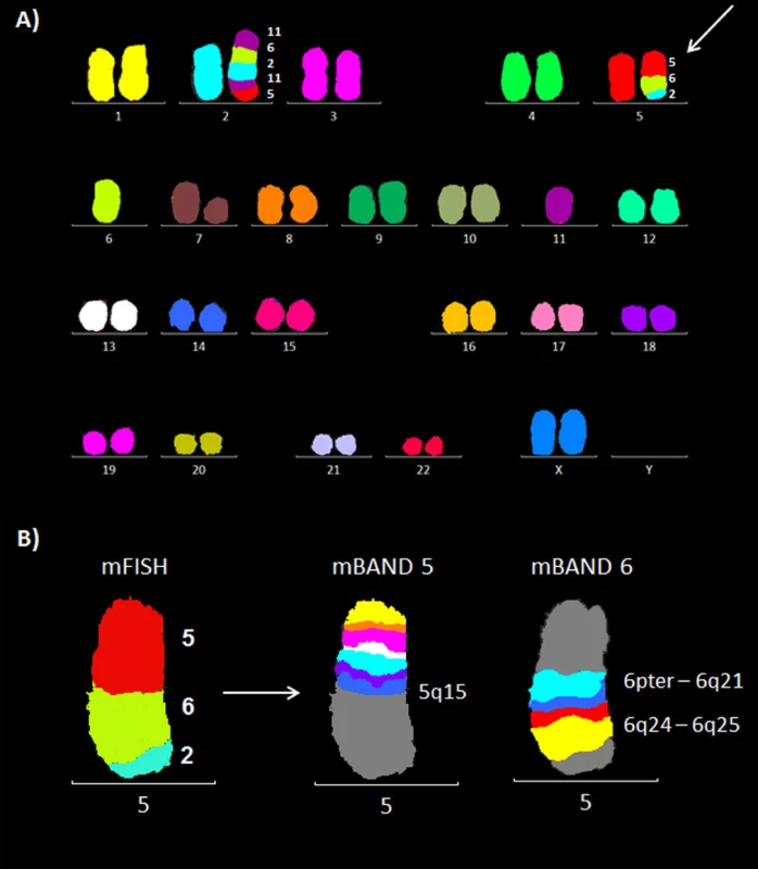 Molekulárně cytogenetická analýza karyotypu pacienta 1. A) Mnohobarevná fluorescenční in situ hybridizace (mFISH). B) Mnohobarevné pruhování s vysokou rozlišovací schopností (mBAND) pro chromozomy 5 a 6.