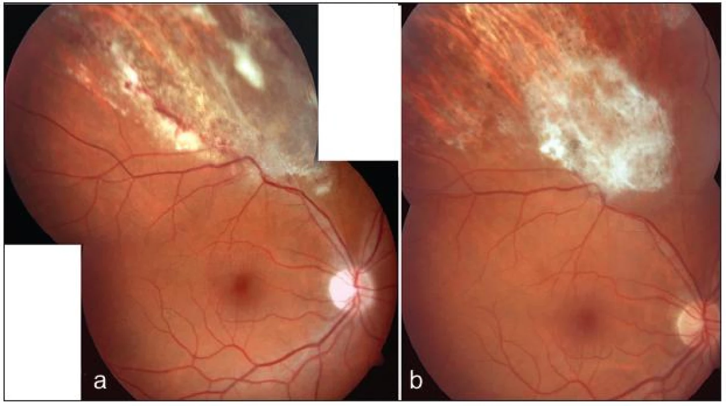 Cytomegalovirová retinitida u pacienta s ulcerózní kolitidou. Ložisko retinitidy s aktivními okraji a hemoragiemi (a). Jizva po přeléčení virostatiky (b)