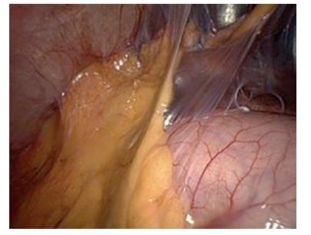 Laparoskopický pohled do podjaterní krajiny po punkční cholecystostomii
Fig. 3: Subhepatic space after percutaneous cholecystostomy – laparoscopic view