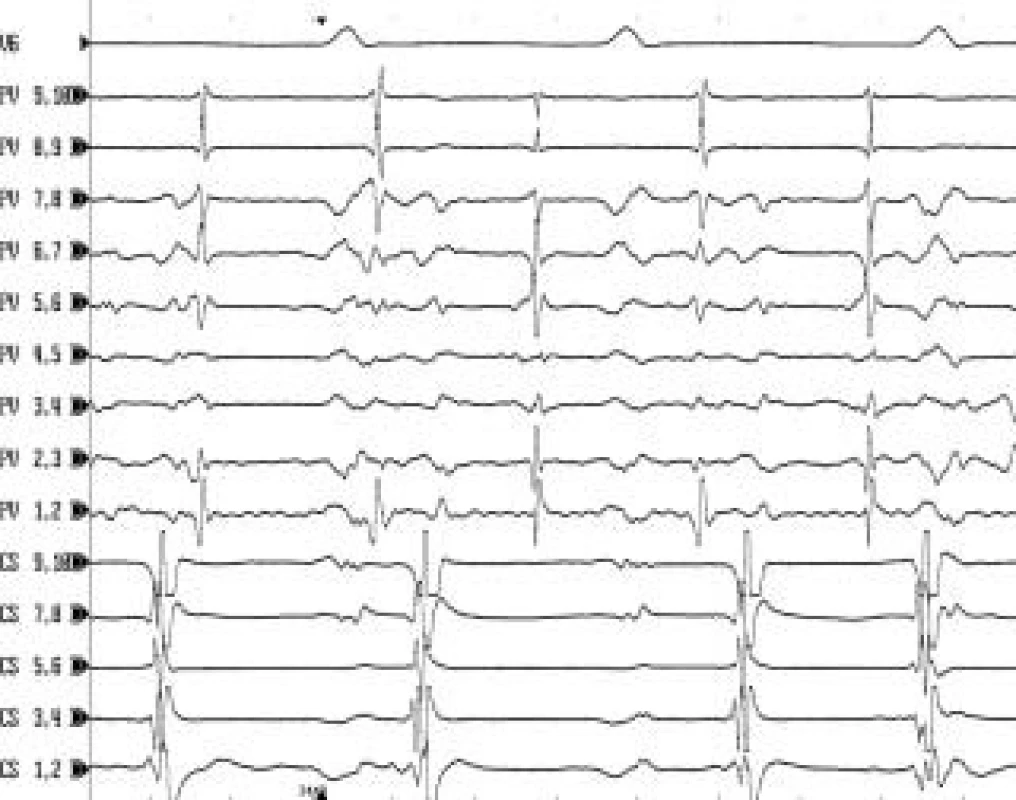 Intrakardiální EKG záznam u pacienta s fokální tachykardií z levé horní plicní žíly.
V intrakardiálním záznamu snímaném 10polárním cirkulárním katétrem v levé horní plicní žíle (PV 1,2–PV 9,10) běží pravidelná síňová tachykardie (ostré potenciály), která se z plicní žíly nepropaguje na levou síň v sekvenci 1 : 1. Výsledkem je nepravidelná aktivace levé síně (viz záznam z koronárního sinu CS 1,2–CS 9,10). Katetrová ablace u pacientů s fokální tachykardií z plicní žíly se provádí metodou izolace plicní žíly pomocí obkružující radiofrekvenční léze podobně jako u pacientů s fibrilací síní. Rychlost posunu EKG záznamu je 200 mm/s.