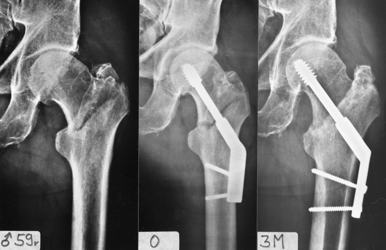 Osteosyntéza pertrochanterické zlomeniny pomocí DHS s 2otvorovou dlahou: a – stabilní pertrochanterická zlomenina; b – rtg po operaci; c – zhojení zlomeniny 3 měsíce po operaci.
Fig. 3: Internal fixation of a pertrochanteric fracture by DHS with a 2-hole plate: a – a stable pertrochanteric fracture; b – postoperative radiograph; c – fracture healed 3 months after operation.
