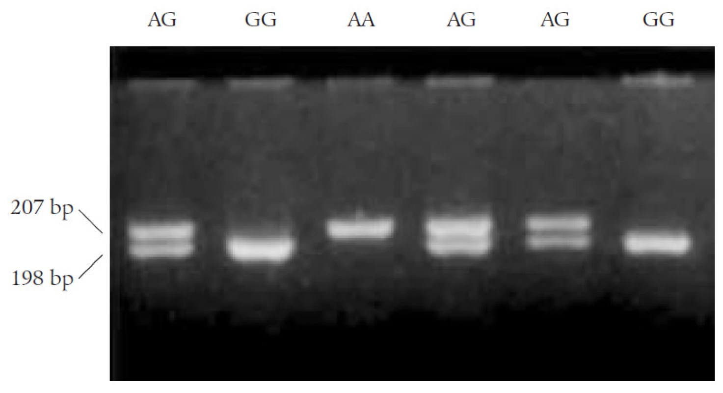Genotypy polymorfizmu Arg16Gly genu pro β&lt;sub&gt;2&lt;/sub&gt;-adrenergní receptor, Arg16 (wild type) fragment 207 bp genotyp AA homozygot, Gly16 (polymorfizmus, záměna adeninu za guanin v sekvenci DNA jediného exonu, vznik restrikčního místa pro NcoI restrikční enzym), genotyp GG homozygot, fragment DNA o 189 + 18 bp, genotyp AG heterozygot B2AR genu detekován na 3% agarózovém gelu jako dva fragmenty o 207 a 189 bp.