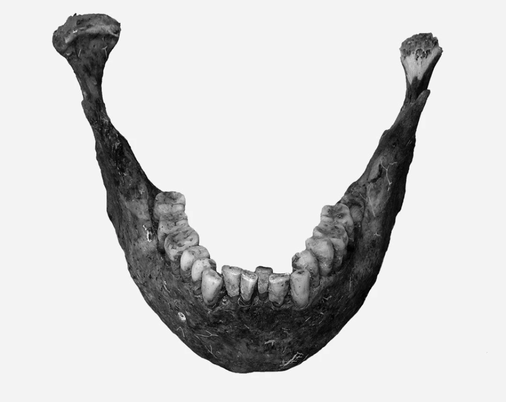 Mandibula 30–40letého muže (z hrobu č. A 829) se stěsnáním frontálních zubů v dolním zubním oblouku. Vedle mesiálních řezáků se v jedné linii nacházejí špičáky, distální řezáky jsou vysunuty linguálním směrem.